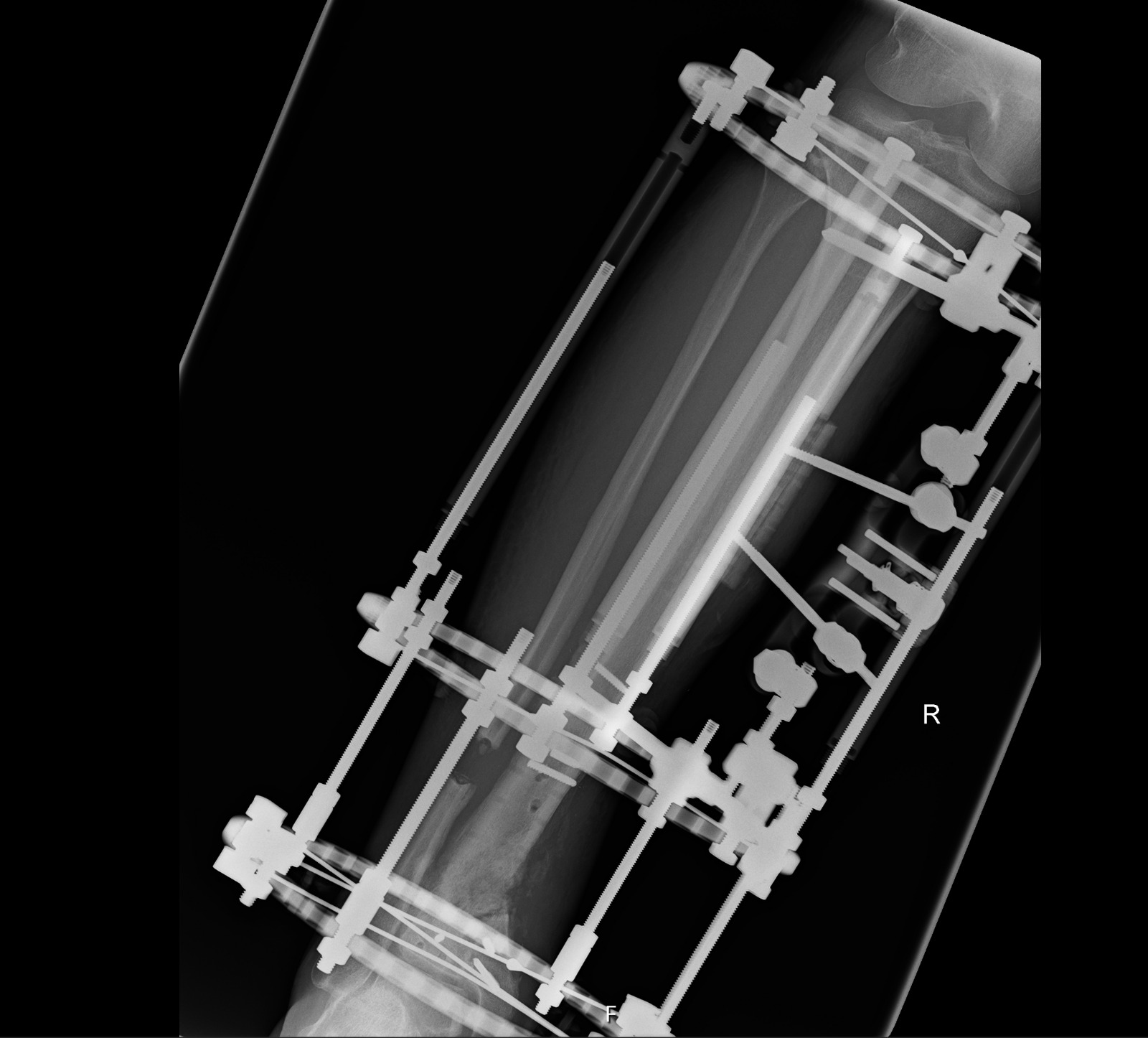 Transverse Cortical Tibial Transport — clinical application